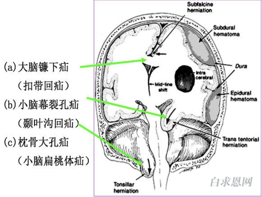 脑疝的临床表现及_第3页