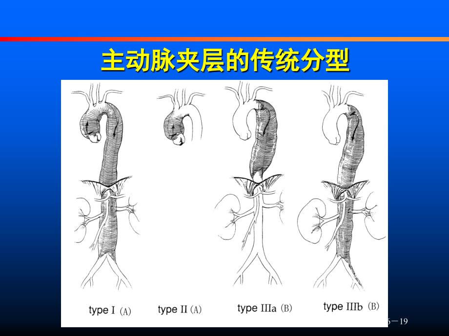 主动脉夹层的改良分型及治疗策略_第3页