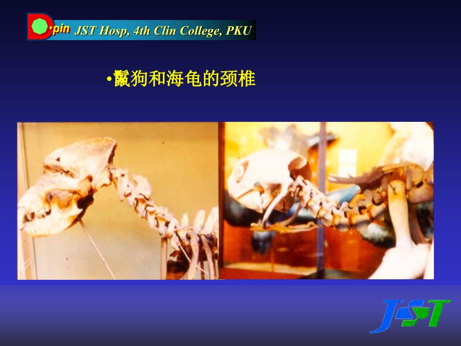 寰枢椎旋转半脱位课件.ppt_第4页