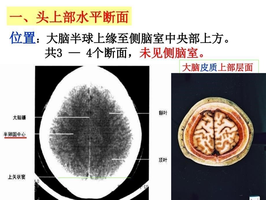 断解脑水平切课件_第5页