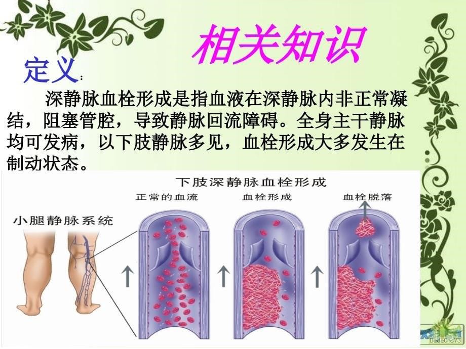 下肢深静脉血栓护理查房_第5页