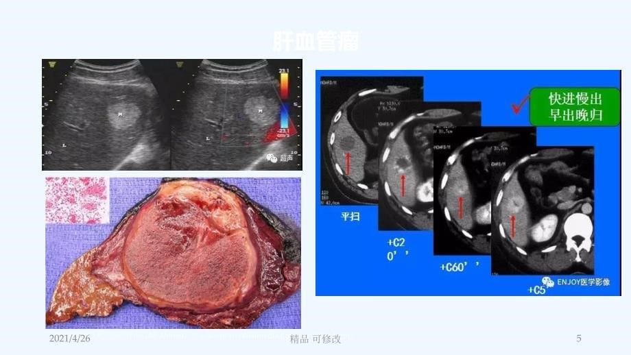 肝脏良性肿瘤的诊治精品课件_第5页