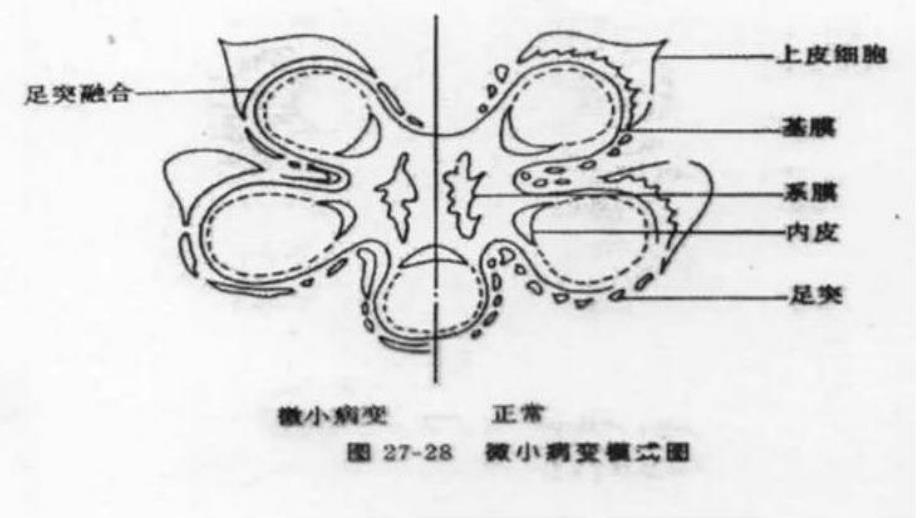 儿科肾病综合症_第4页