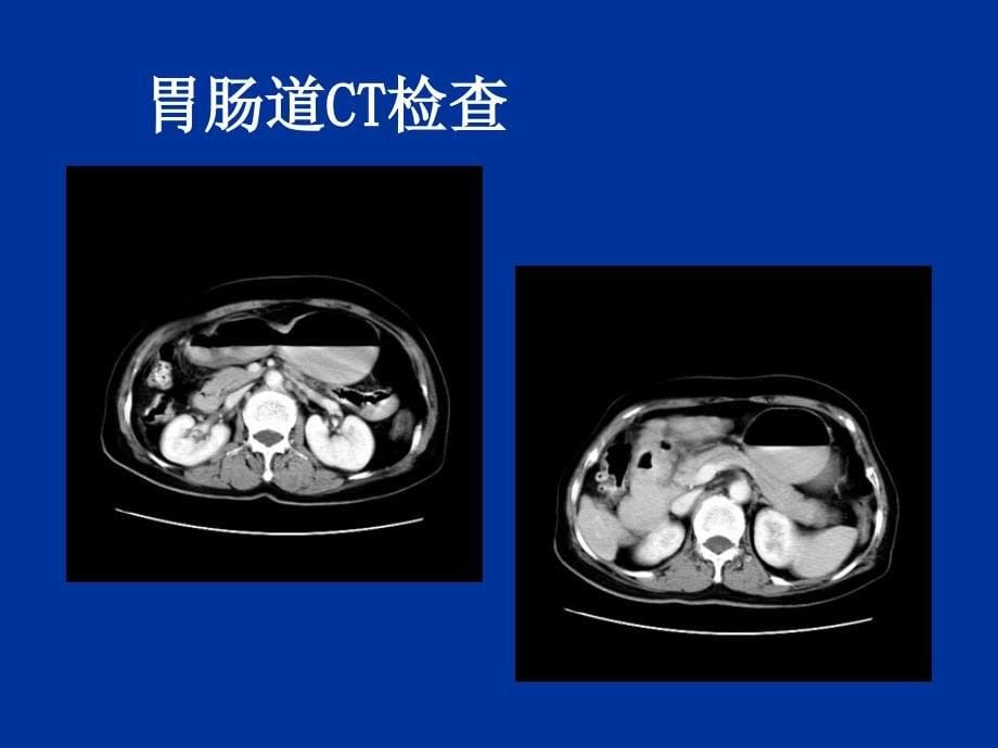 精品推荐医学影像诊断课件图文详解完整版-消化系统影像诊断_第5页