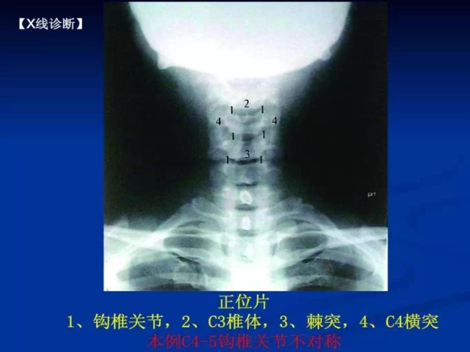 脊柱阅片入门指导课件_第5页