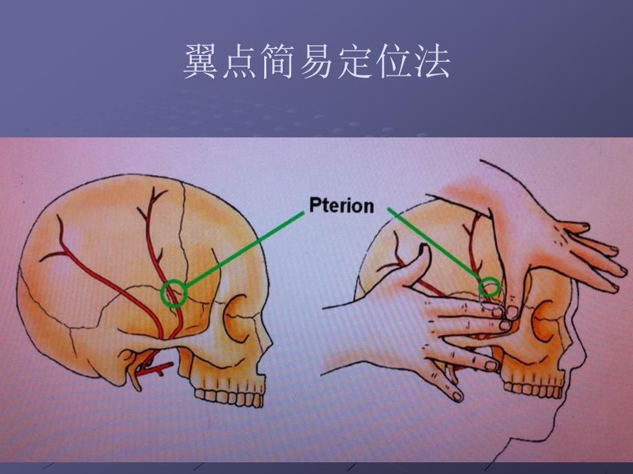 翼点入路解剖课件_第5页