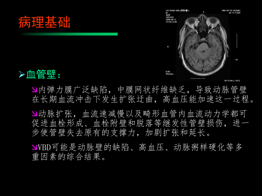 椎基底动脉扩张延长症ppt课件_第3页