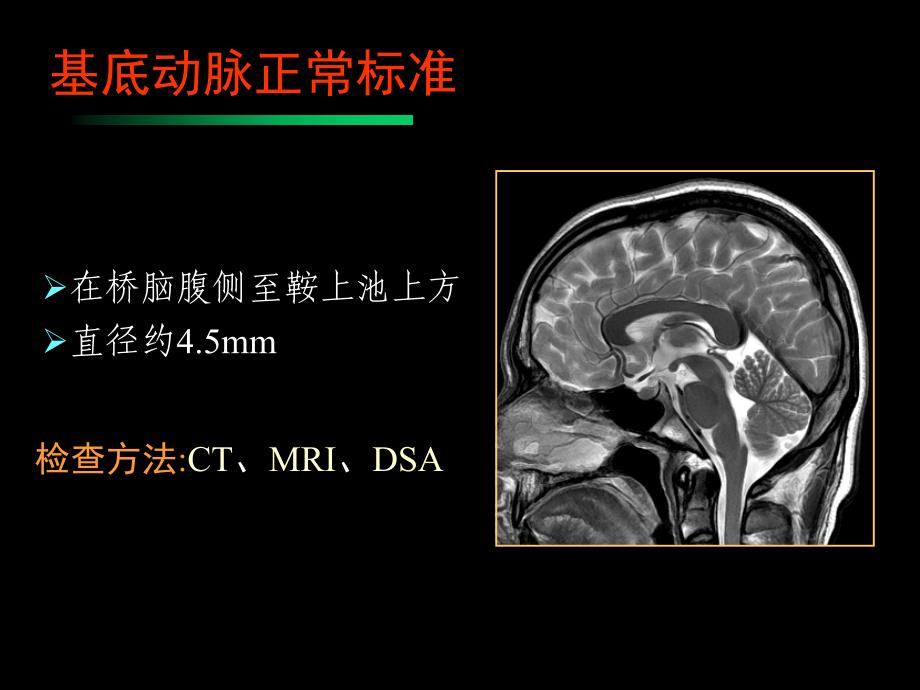 椎基底动脉扩张延长症ppt课件_第4页