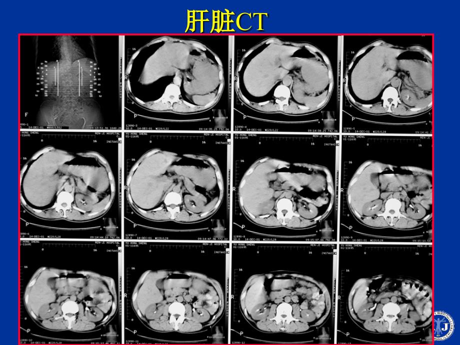 肝脏疾病影像诊断学.ppt_第4页