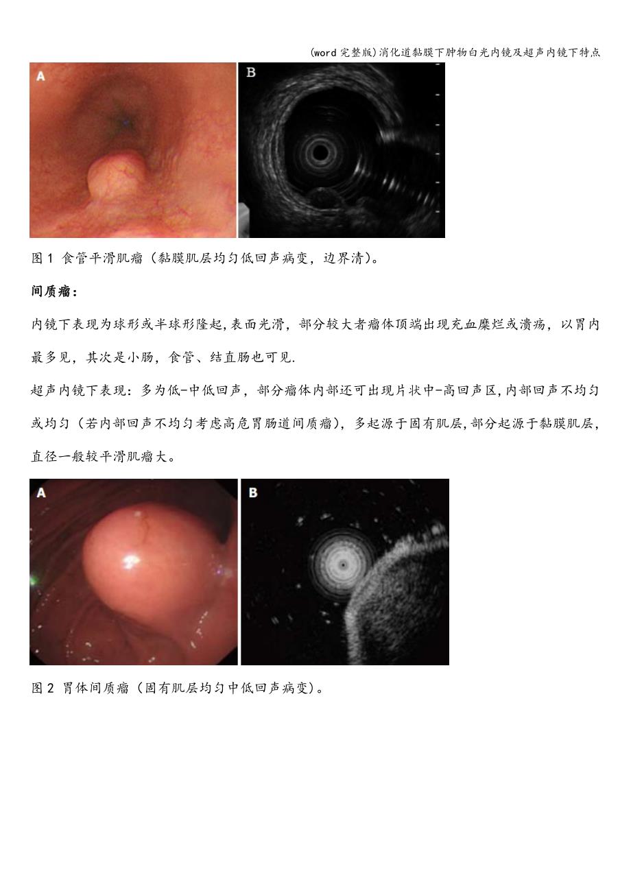 (word完整版)消化道黏膜下肿物白光内镜及超声内镜下特点.doc_第2页