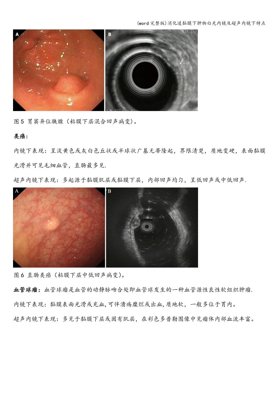(word完整版)消化道黏膜下肿物白光内镜及超声内镜下特点.doc_第4页