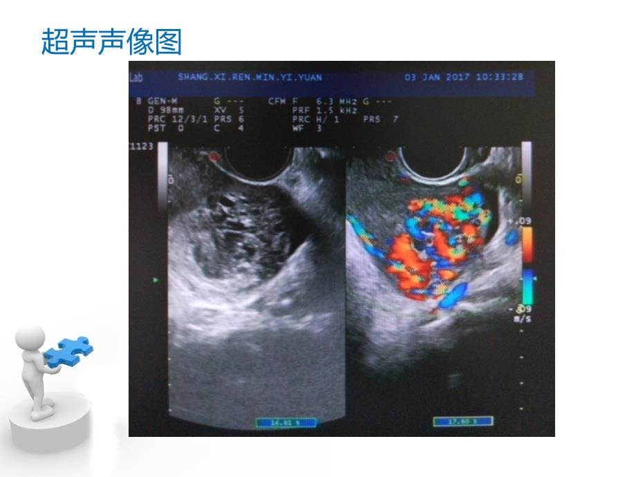 子宫动静脉超声诊断ppt课件_第4页