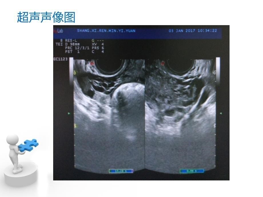 子宫动静脉超声诊断ppt课件_第5页