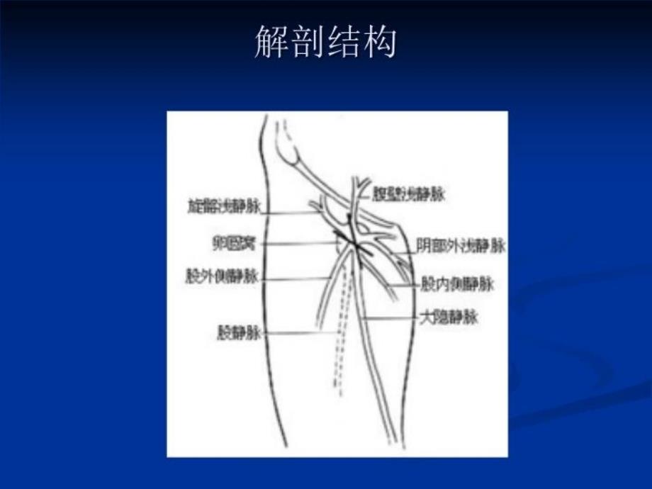 最新大隐静脉曲张教学课件_第4页