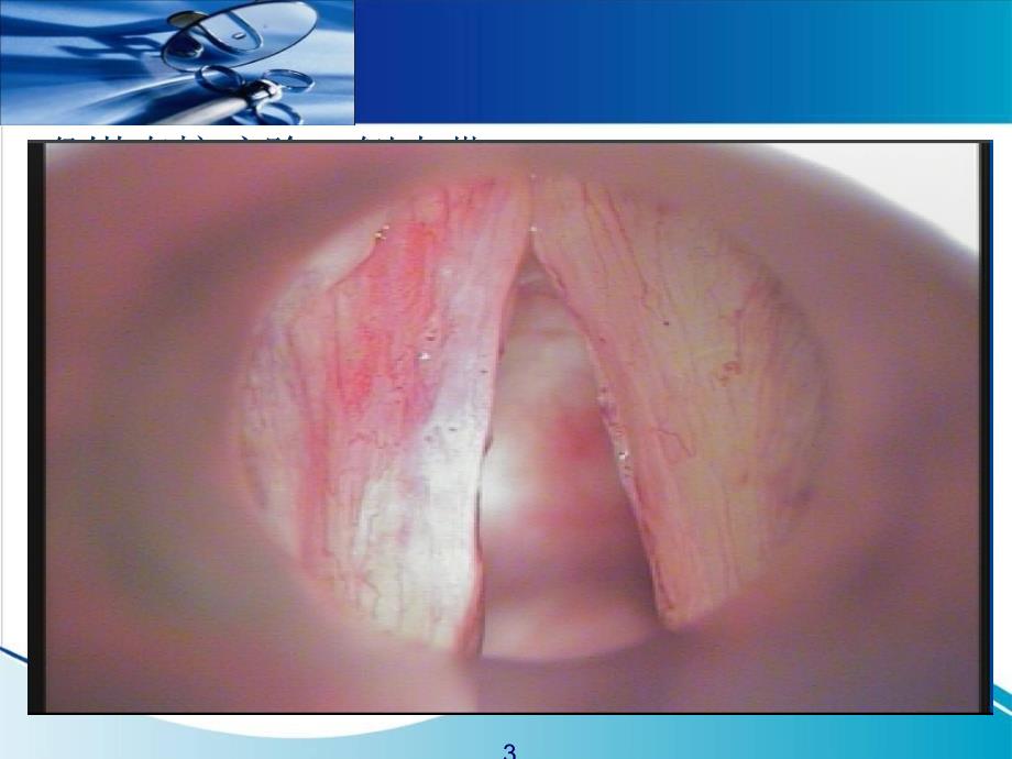 动态喉镜在声带沟的应用ppt课件_第3页
