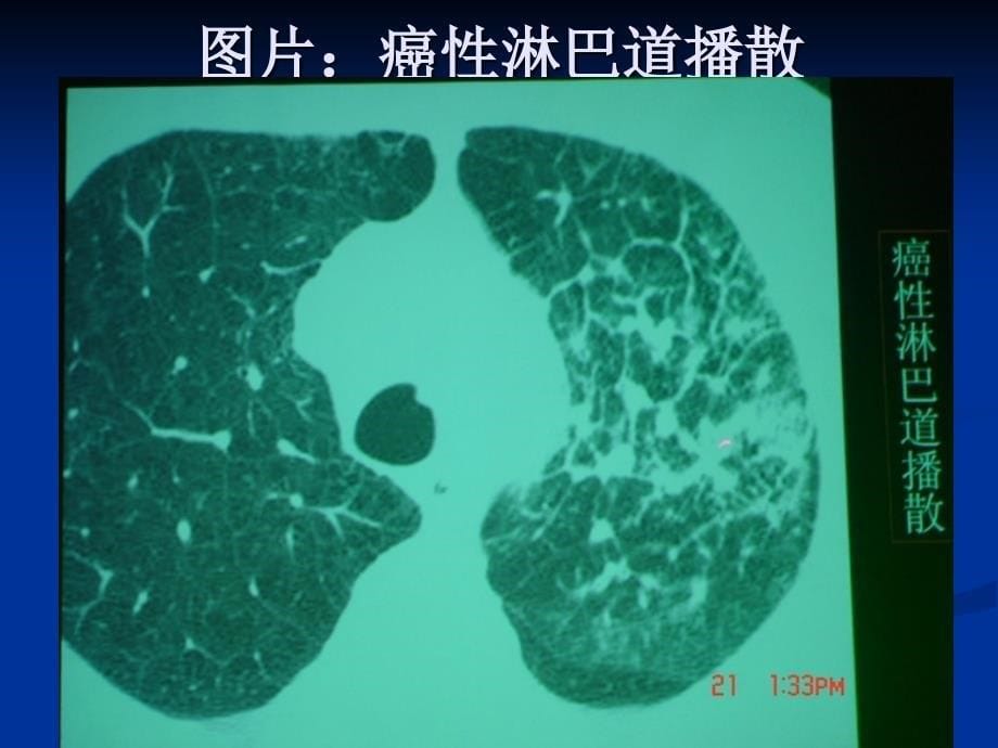 肺部HRCT十大常见征象分析课件_第5页