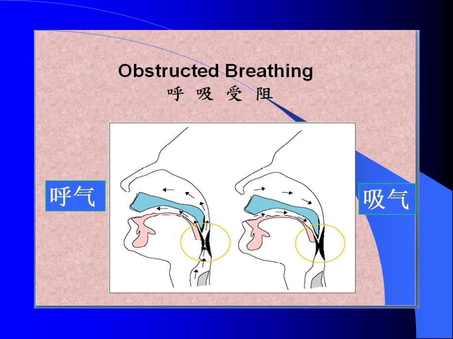 最新：阻塞性睡眠呼吸暂停低通气综合征病人的护理文档资料_第4页