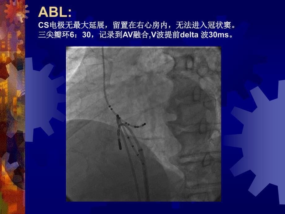 ebstein畸形合并预激综合征并冠状静脉汇入左心房一例文档资料_第5页