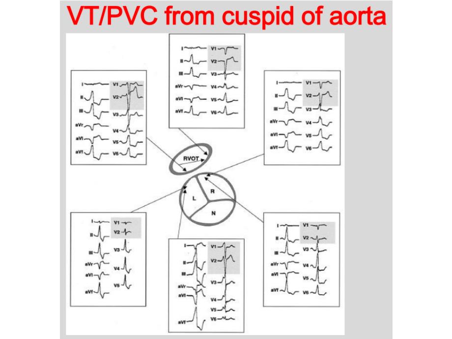 室早室速体表心电图定位诊断-课件_第4页