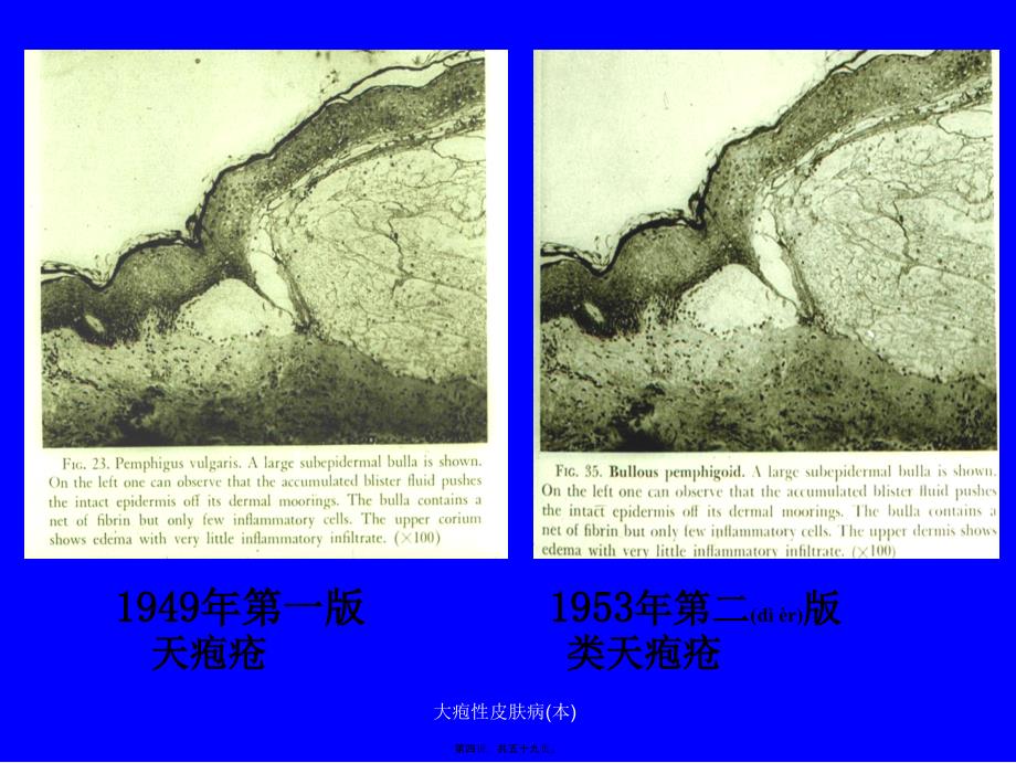 大疱性皮肤病本课件_第4页