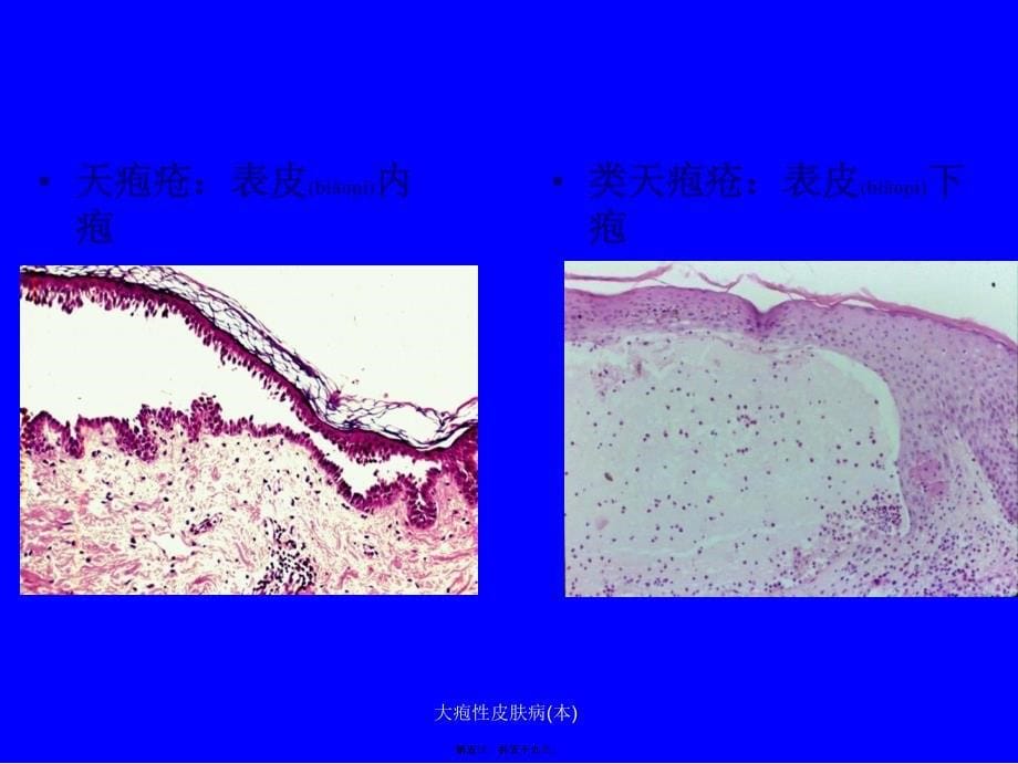 大疱性皮肤病本课件_第5页