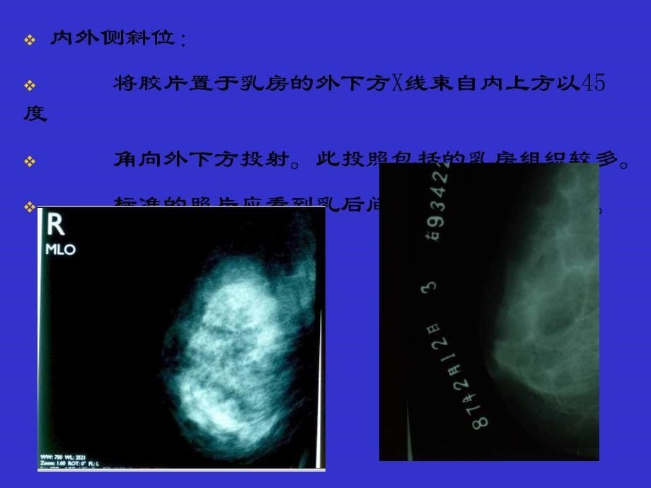 乳腺钼靶拍片体位与检查方法_第5页