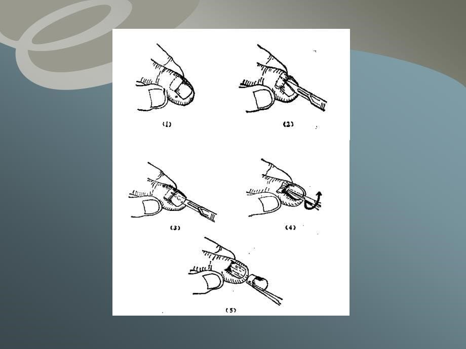 外科小手术教学.ppt_第5页