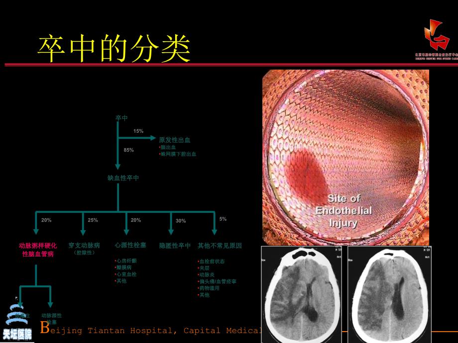 缺血性卒中的抗栓治疗_第4页