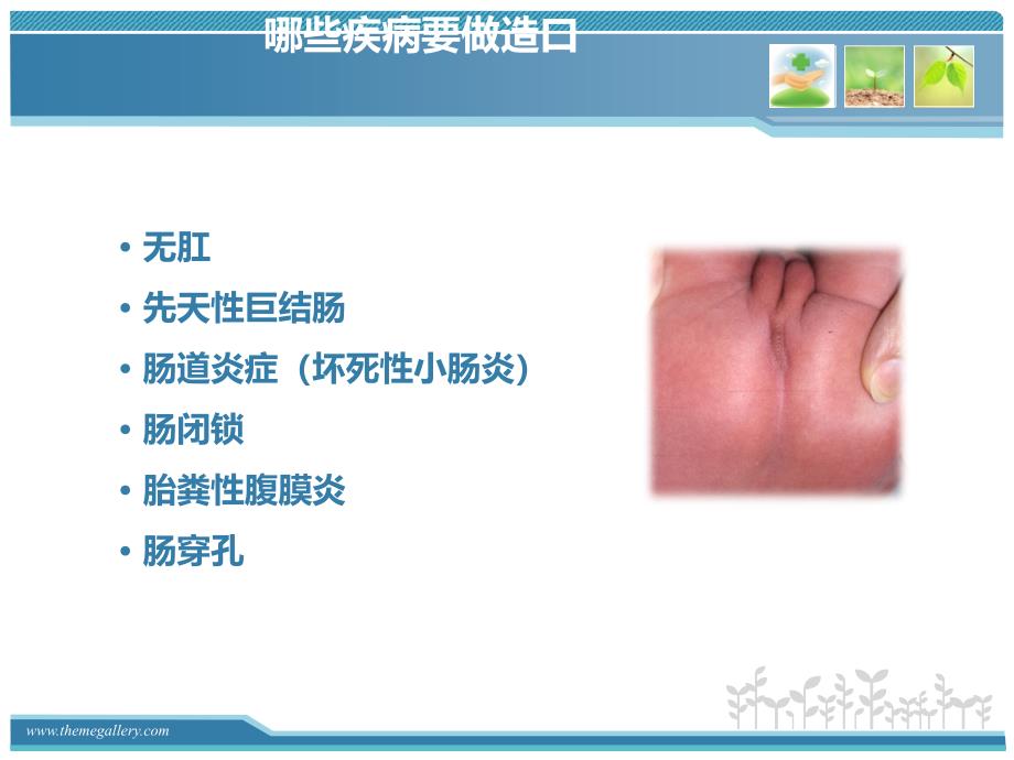 小儿造口护理田俊华_第4页