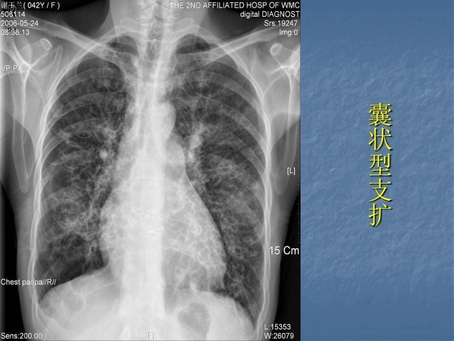 医学影像学：胸部常见病的影像诊断_第5页