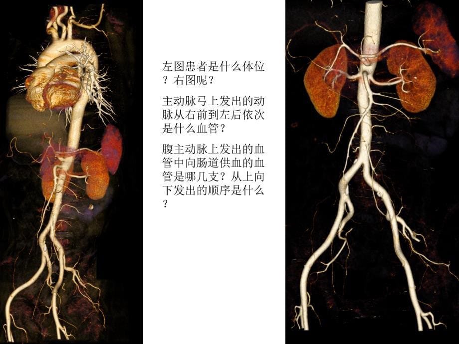 循环系统正常影像学现及基本病变 PP课件_第5页