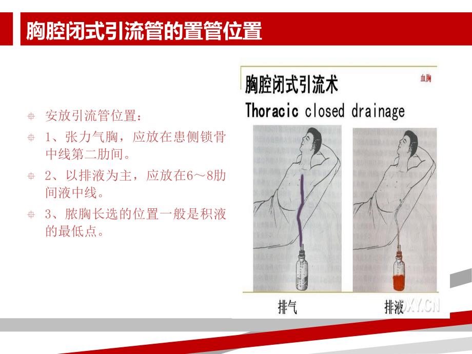 胸腔闭式引流的护理及注意事项.ppt课件_第4页