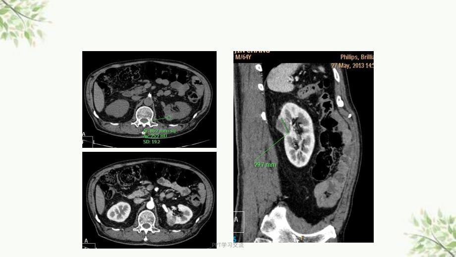 肾癌的CT表现课件_第3页