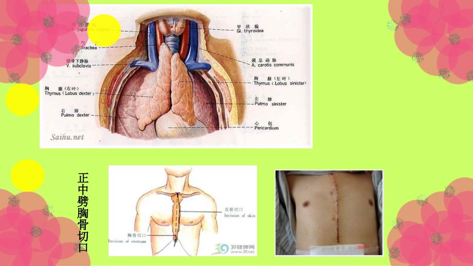 胸腺瘤护理查房_第3页