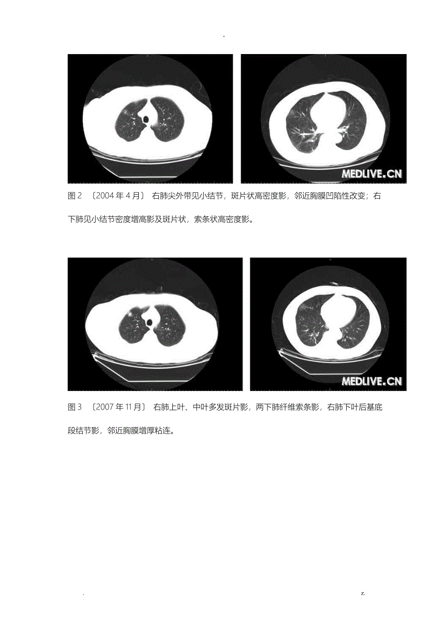 肺部结节8年病例分析_第2页