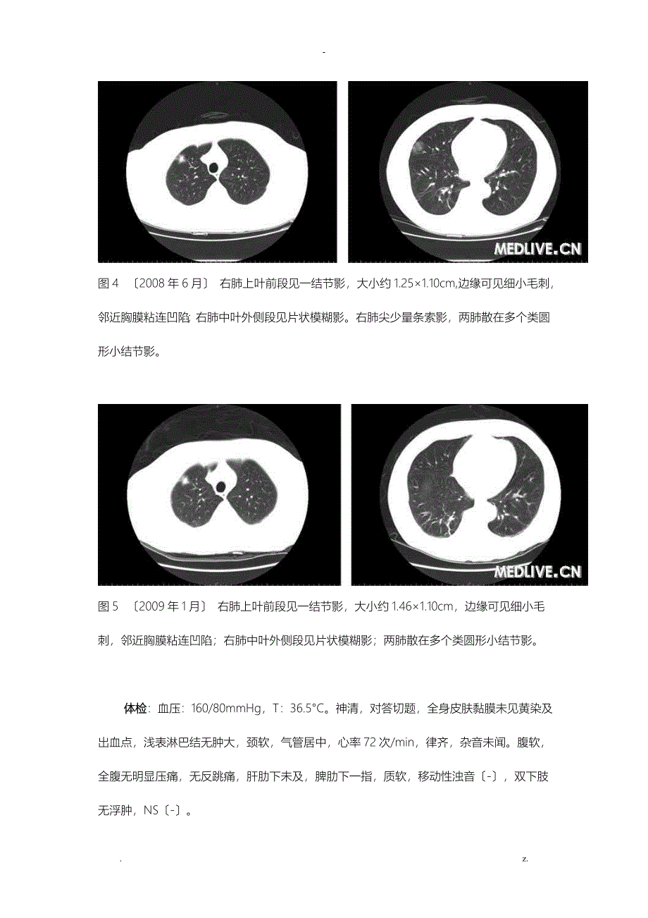 肺部结节8年病例分析_第3页