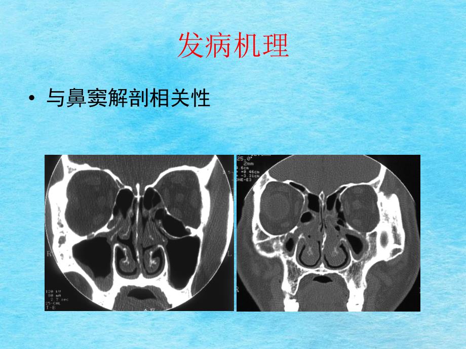 鼻窦炎及并发症ppt课件_第3页