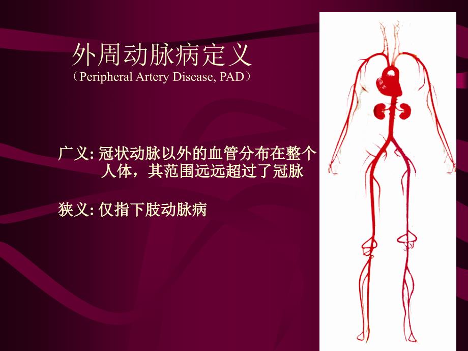 PAD诊断与治疗普及ppt课件_第2页