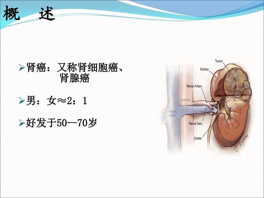 泌尿系统肿瘤患者的护理.ppt_第5页