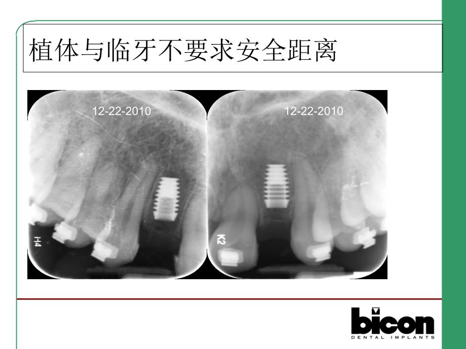 Bicon口腔种植系统简介1_第4页