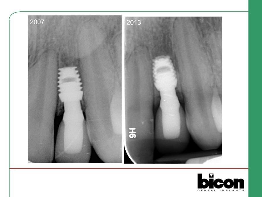 Bicon口腔种植系统简介1_第5页