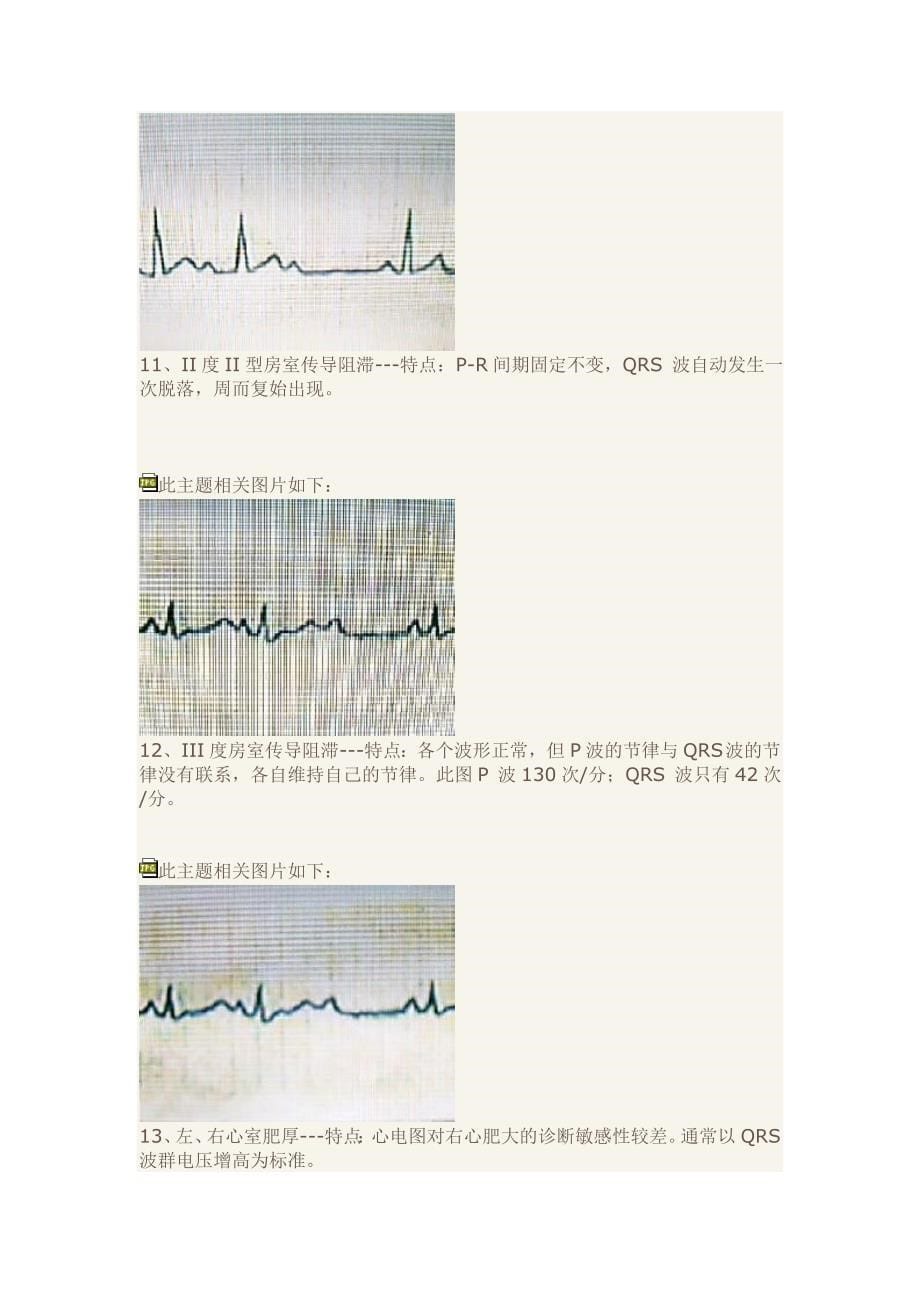 快速学习心电图(精品)_第5页