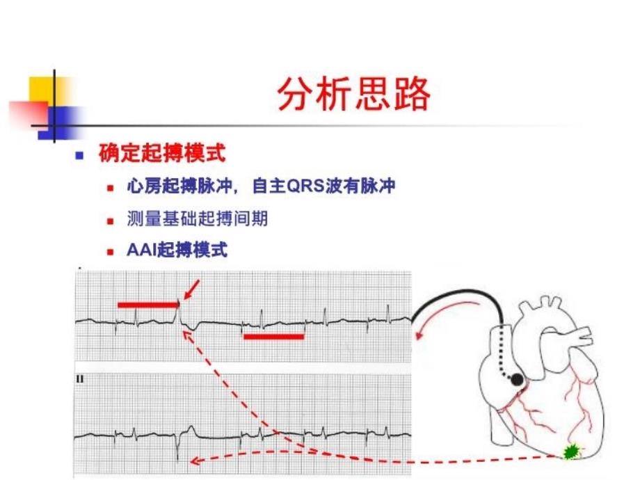 最新复杂疑难起搏心电图阅读技巧幻灯片_第4页