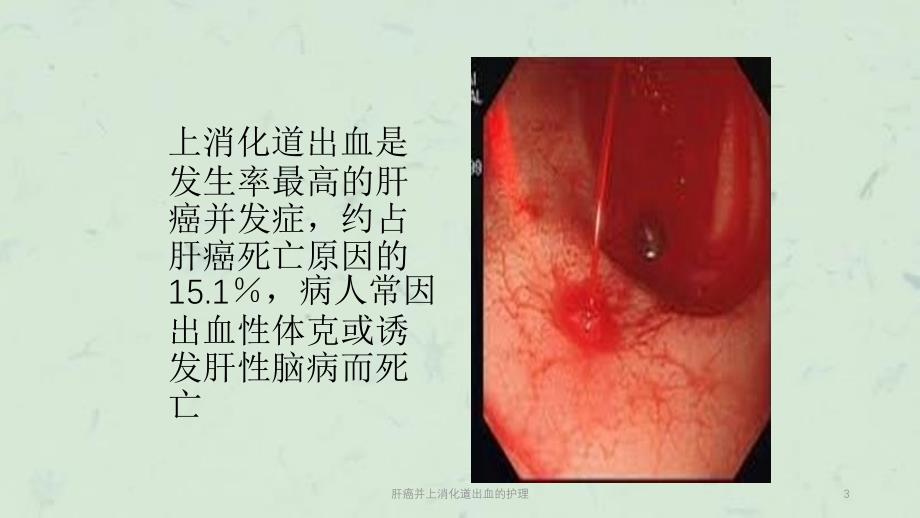 肝癌并上消化道出血的护理课件_第3页