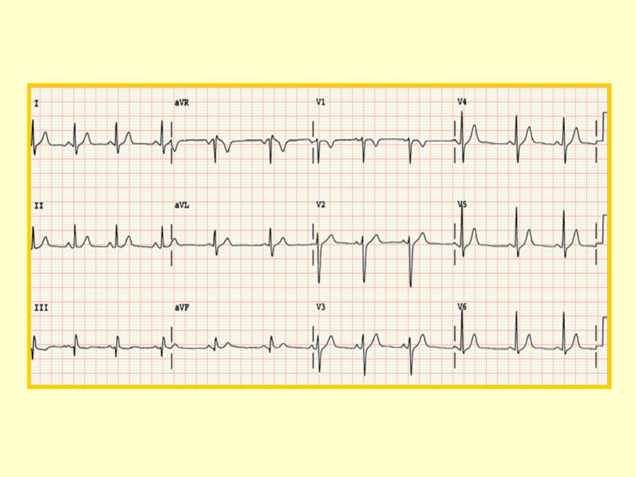 心电图基本知识69_第2页