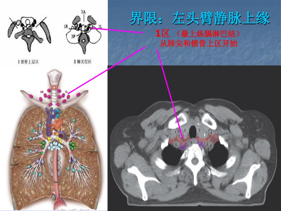 肺部淋巴结分组勾画幻灯_第4页