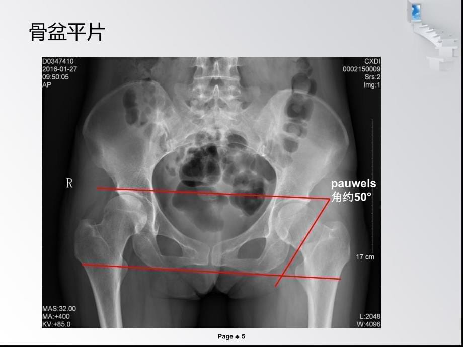 股骨颈骨折空心钉_第5页