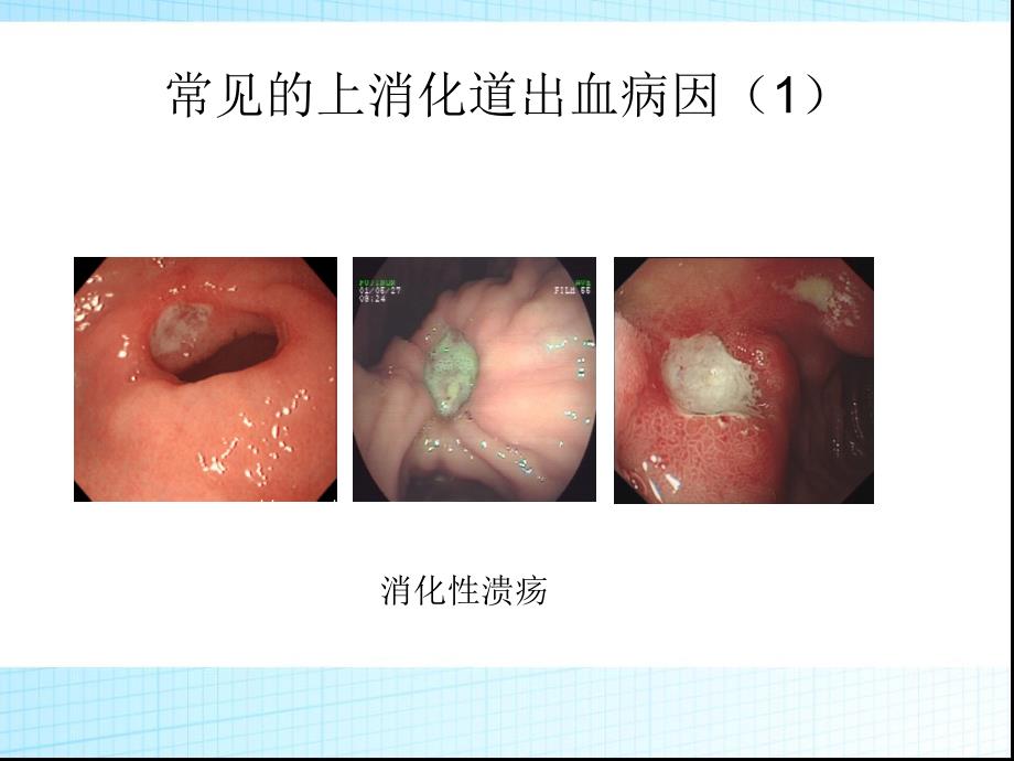 最新急诊——上消化道出血的诊断与处理PPT文档_第4页