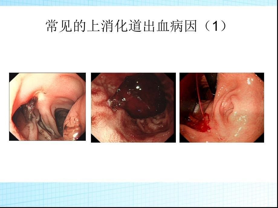 最新急诊——上消化道出血的诊断与处理PPT文档_第5页