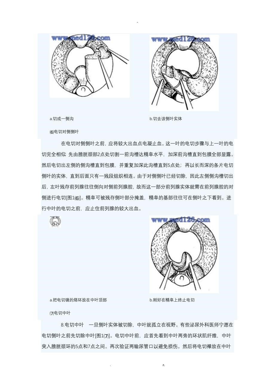 前列腺切除术的适应证已在开放式前列腺切除术中详细描述_第5页